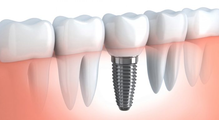 Cliniche dentali ed implantologia